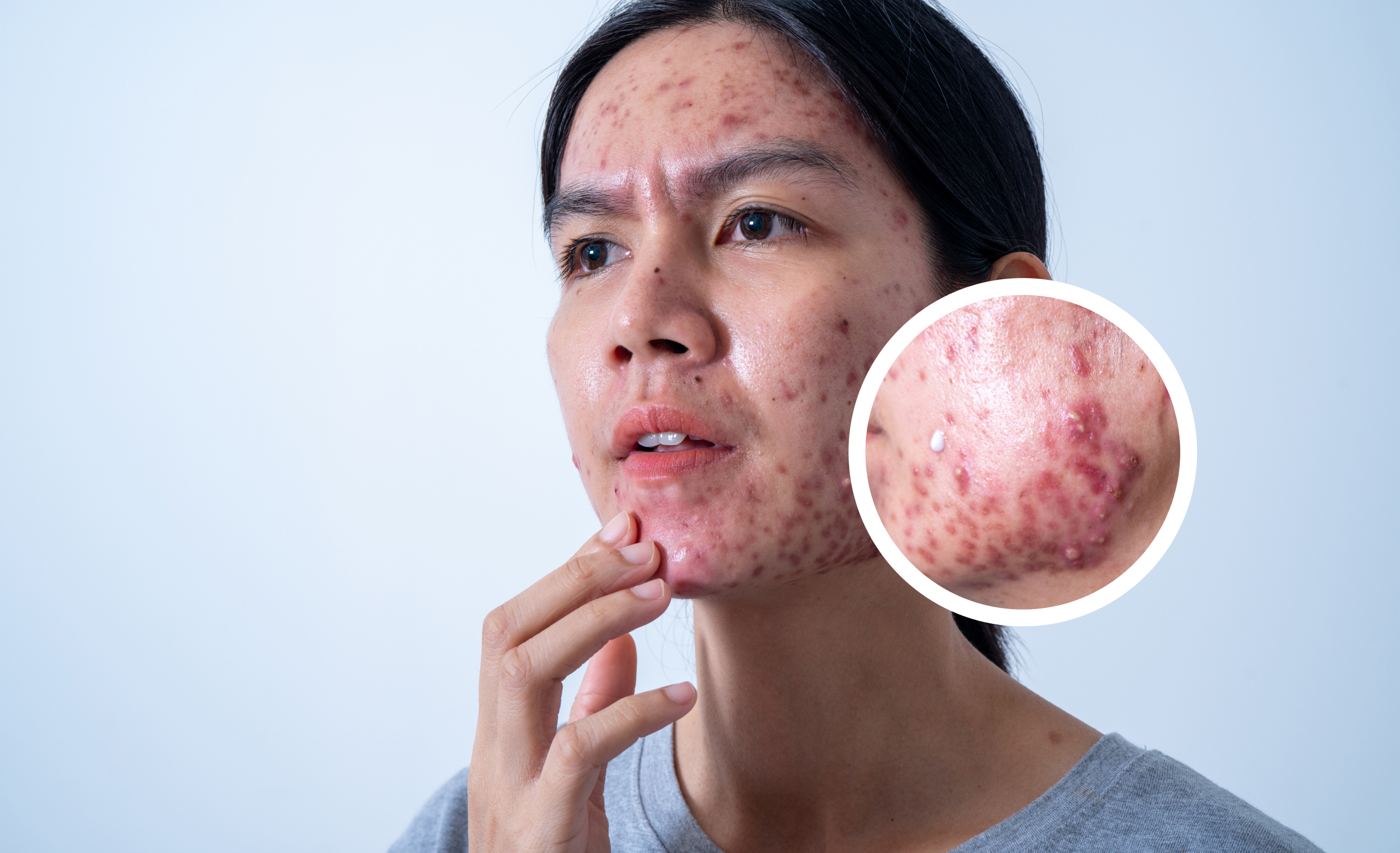 A close-up image of a person experiencing severe acne breakouts. An inset magnifies a section of the skin, highlighting the inflamed and pustular nature of the acne.