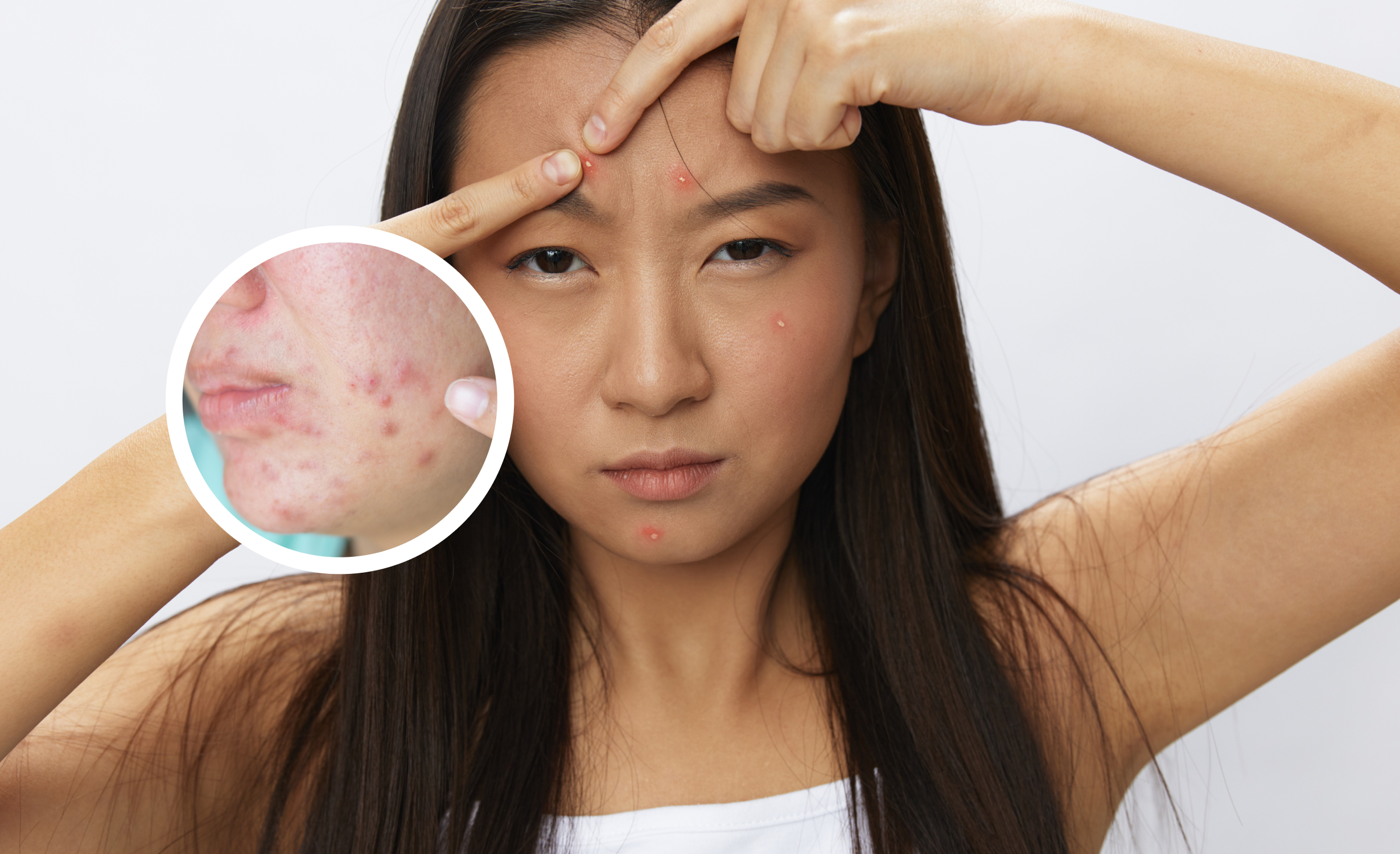 A young woman with a frustrated expression points to acne scars on her forehead. An inset magnifies a section of the skin, highlighting the acne scars and blemishes.