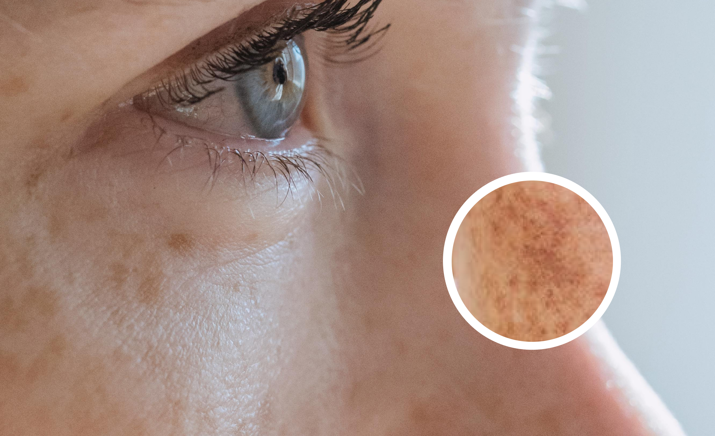 A close-up side view of a person’s eye, focusing on the skin around the eye area. There is visible pigmentation on the skin. An inset magnifies a section of the pigmented skin, highlighting the texture and color variations.