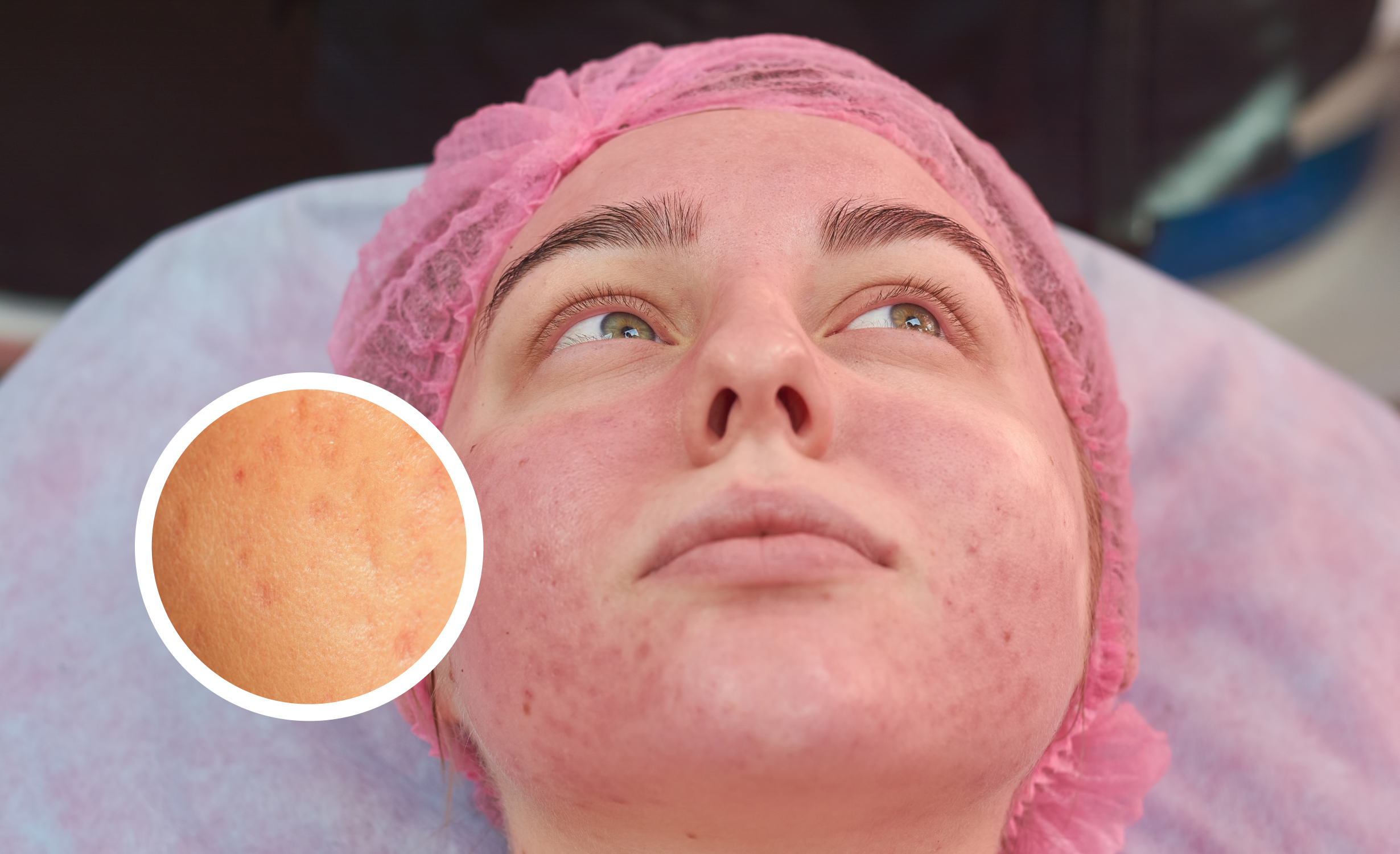 A close-up of a young woman lying down, showing redness and flushing on her face. She wears a pink head cover. An inset magnifies a section of her irritated skin, highlighting the texture and redness.