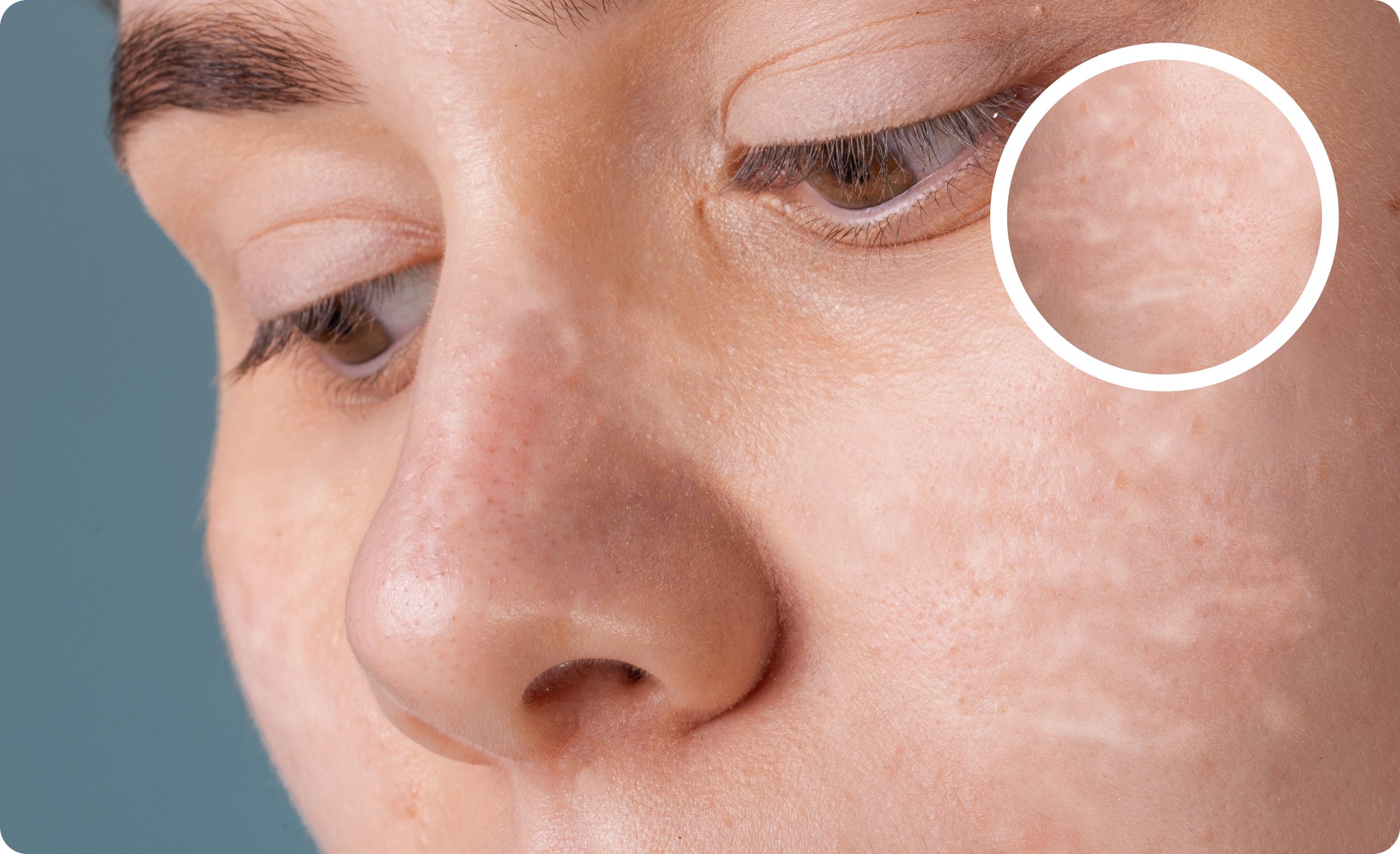 A close-up image of a person with uneven skin tone condition. An inset magnifies a section of the skin, highlighting areas with pigmentation issues and texture irregularities.